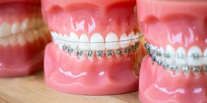 Clear Fixed Ceramic Braces Tunbridge Wells