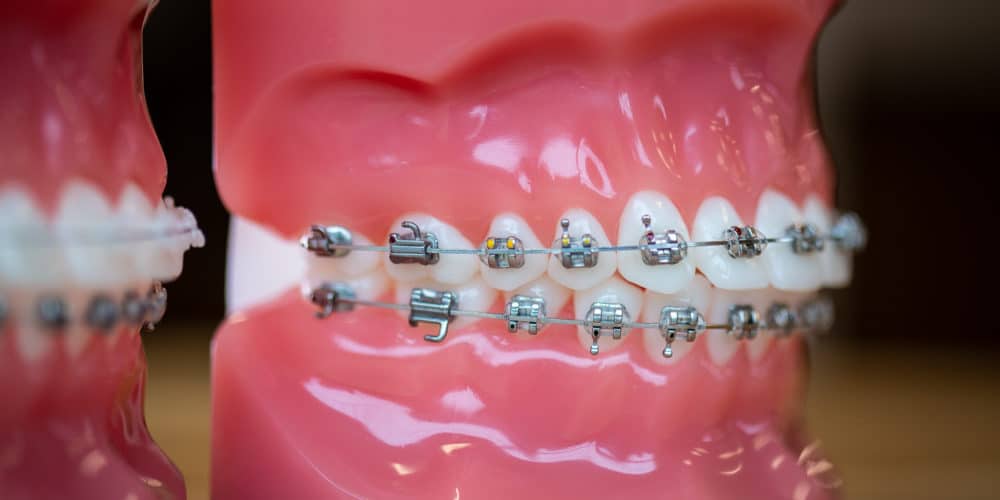 Mpowering Smiles with Braces in Falmouth Mbrace Orthodontics in Maine