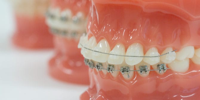 Mbrace Orthodontics Falmouth Maine Orthodontic Office Orthodontic Technology 7 670x335 - Clear Braces for Discreet Treatment
